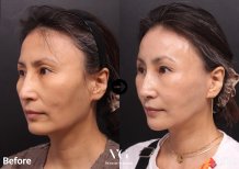 Результаты до и после имплантации подбородка в VG Plastic Surgery – улучшенный контур