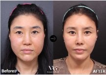 Результаты мини-подтяжки лица до и после в VG Plastic Surgery, видимое омоложение