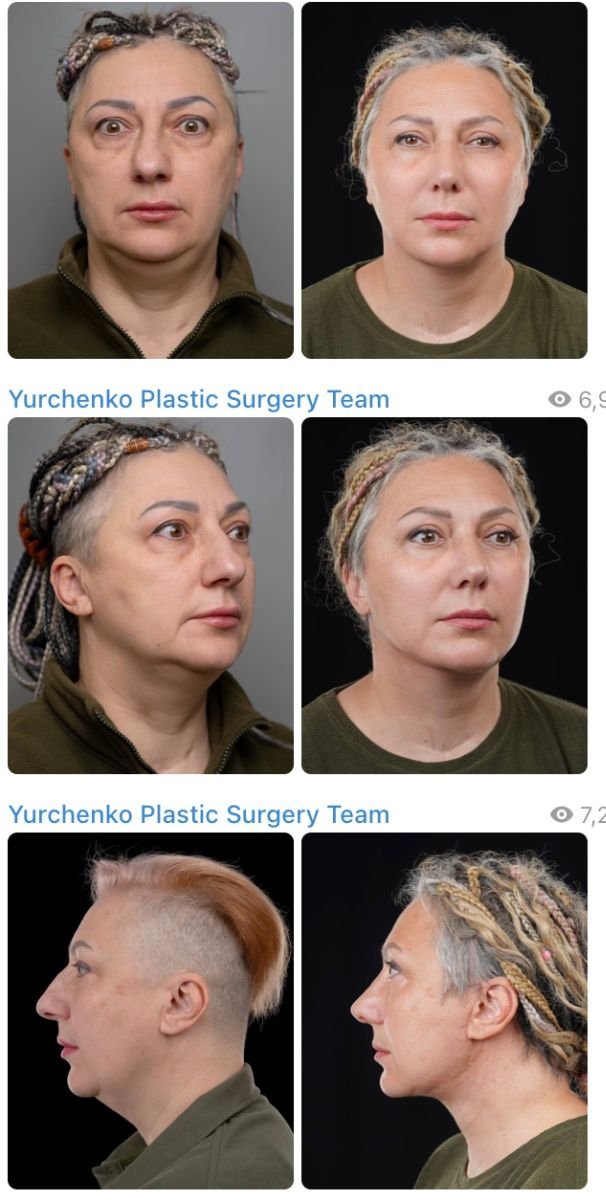 Resultados antes y después de deep plane facelift en Yurchenko Plastic Surgery Team, rejuvenecimiento facial