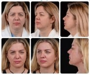 نتائج قبل وبعد شد الوجه العميق في Yurchenko Plastic Surgery Team، تجديد شباب الوجه