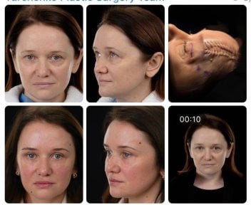 Efekty przed i po deep plane facelift w Yurchenko Plastic Surgery Team, odmłodzenie twarzy