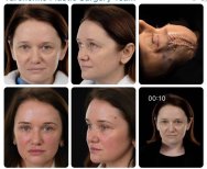 Efekty przed i po deep plane facelift w Yurchenko Plastic Surgery Team, odmłodzenie twarzy