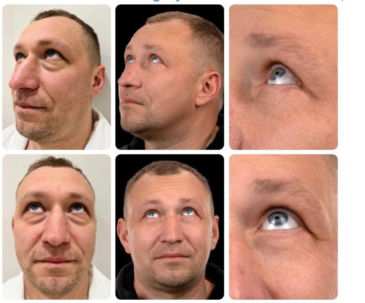 Before and after deep plane facelift results at Yurchenko Plastic Surgery Team, facial rejuvenation