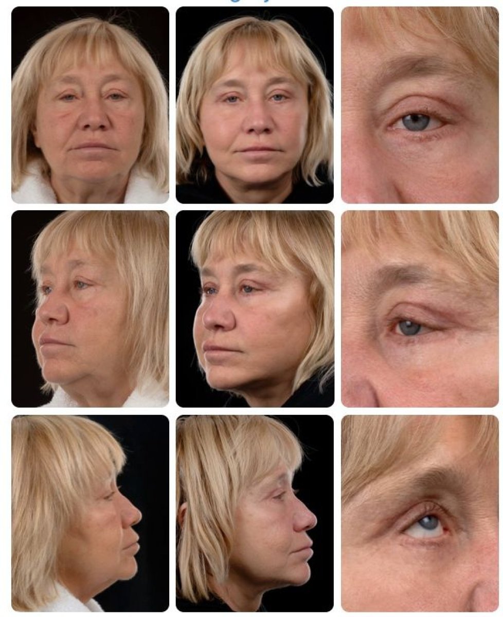 Before and after deep plane facelift results at Yurchenko Plastic Surgery Team, facial rejuvenation
