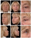 Efekty przed i po deep plane facelift w Yurchenko Plastic Surgery Team, odmłodzenie twarzy