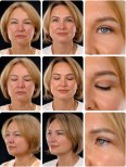 Efekty przed i po deep plane facelift w Yurchenko Plastic Surgery Team, odmłodzenie twarzy