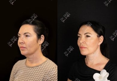 Facelift before and after results at Dr. MED – visible facial rejuvenation and contouring