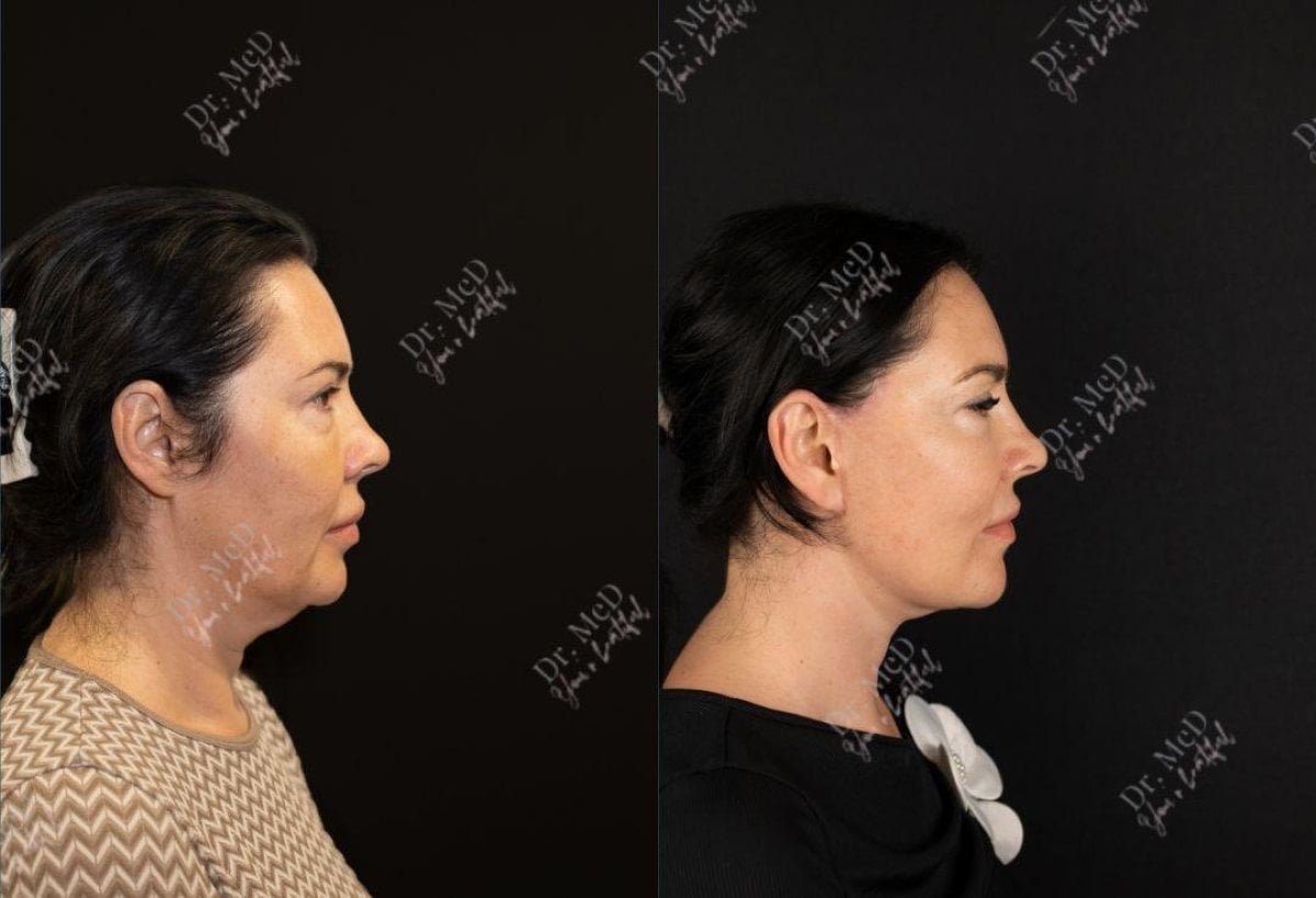 Resultados de lifting facial antes y después en Dr. MED – mejora del contorno mandibular y cuello
