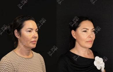 Результаты до и после подтяжки лица в Dr. MED, видимое омоложение и улучшение контура
