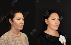 Результаты до и после подтяжки лица в Dr. MED, видимое омоложение и улучшение контура