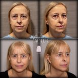 Facelift before and after results at Dr. MED – visible facial rejuvenation and smoother skin