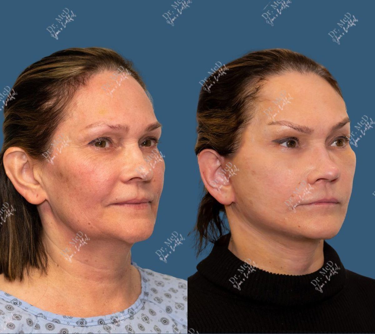 Résultats avant/après lifting des sourcils chez Dr. MED, rajeunissement visible