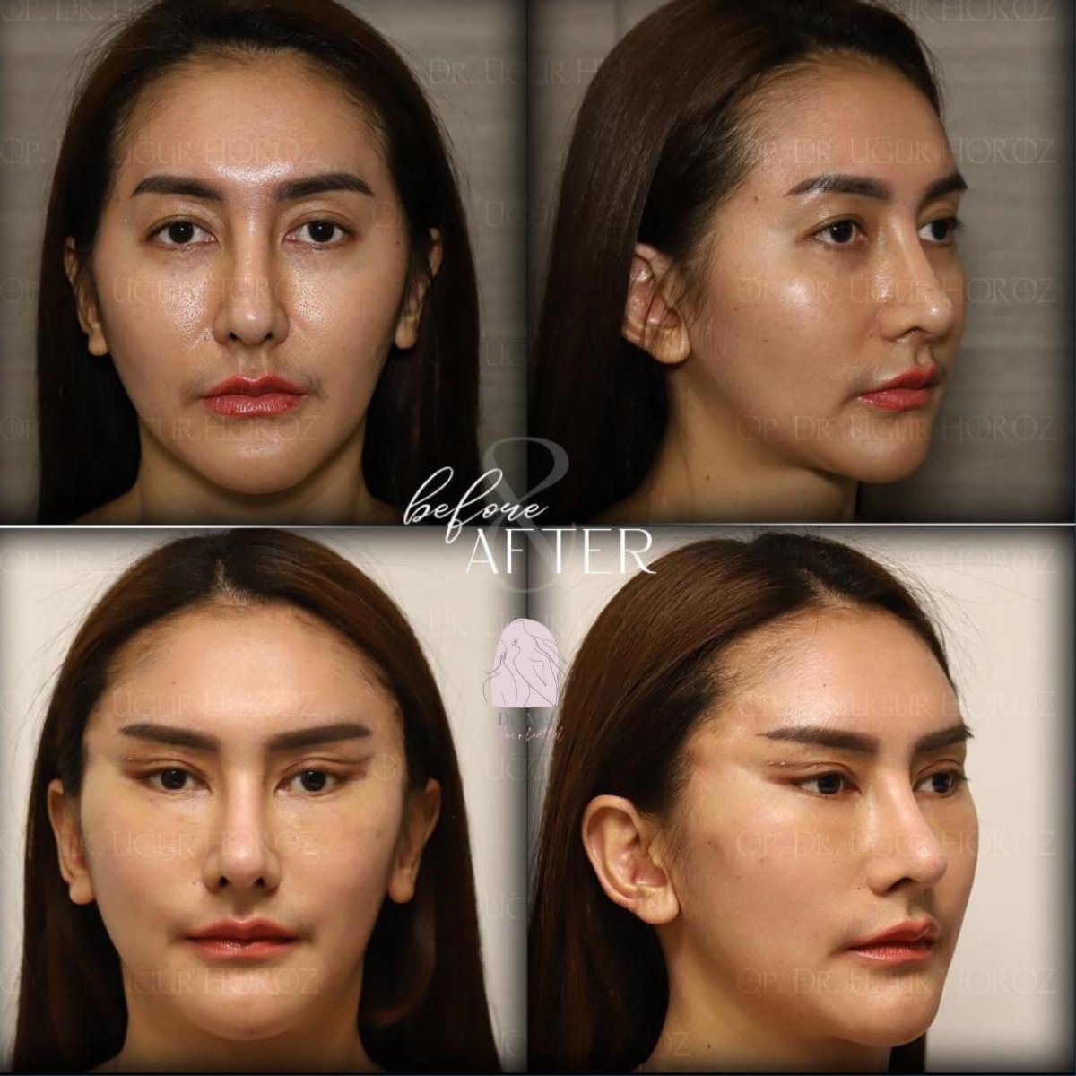 Résultats lifting des sourcils avant/après chez Dr. MED – sourcil relevé, regard rajeuni