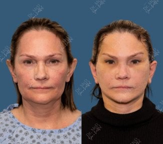 Vorher-nachher-Ergebnis Facelift bei Dr. MED, sichtbare Verjüngung und straffere Haut