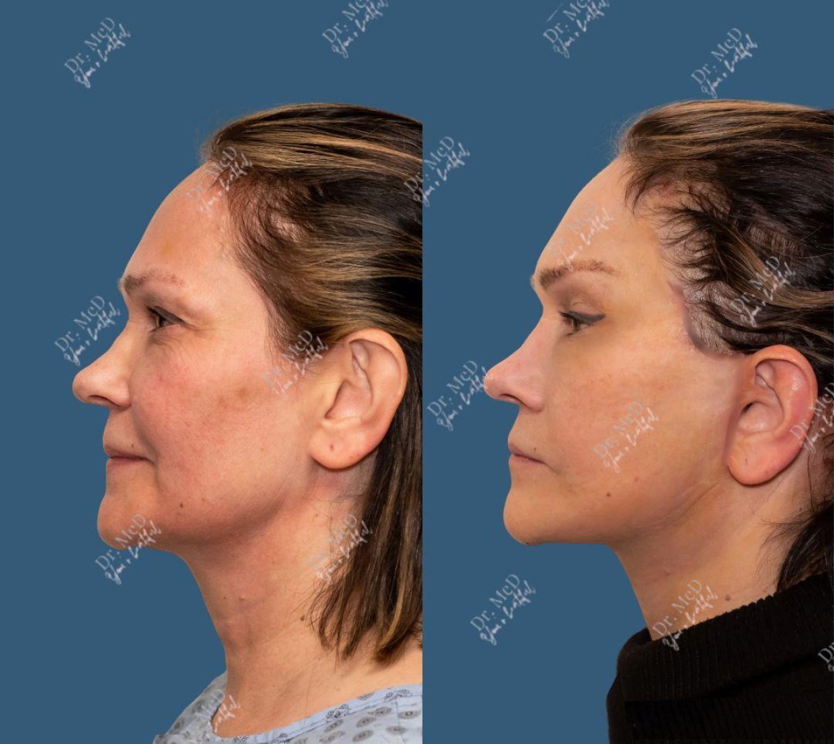Resultados de lifting facial antes y después en Dr. MED – rejuvenecimiento y mandíbula firme