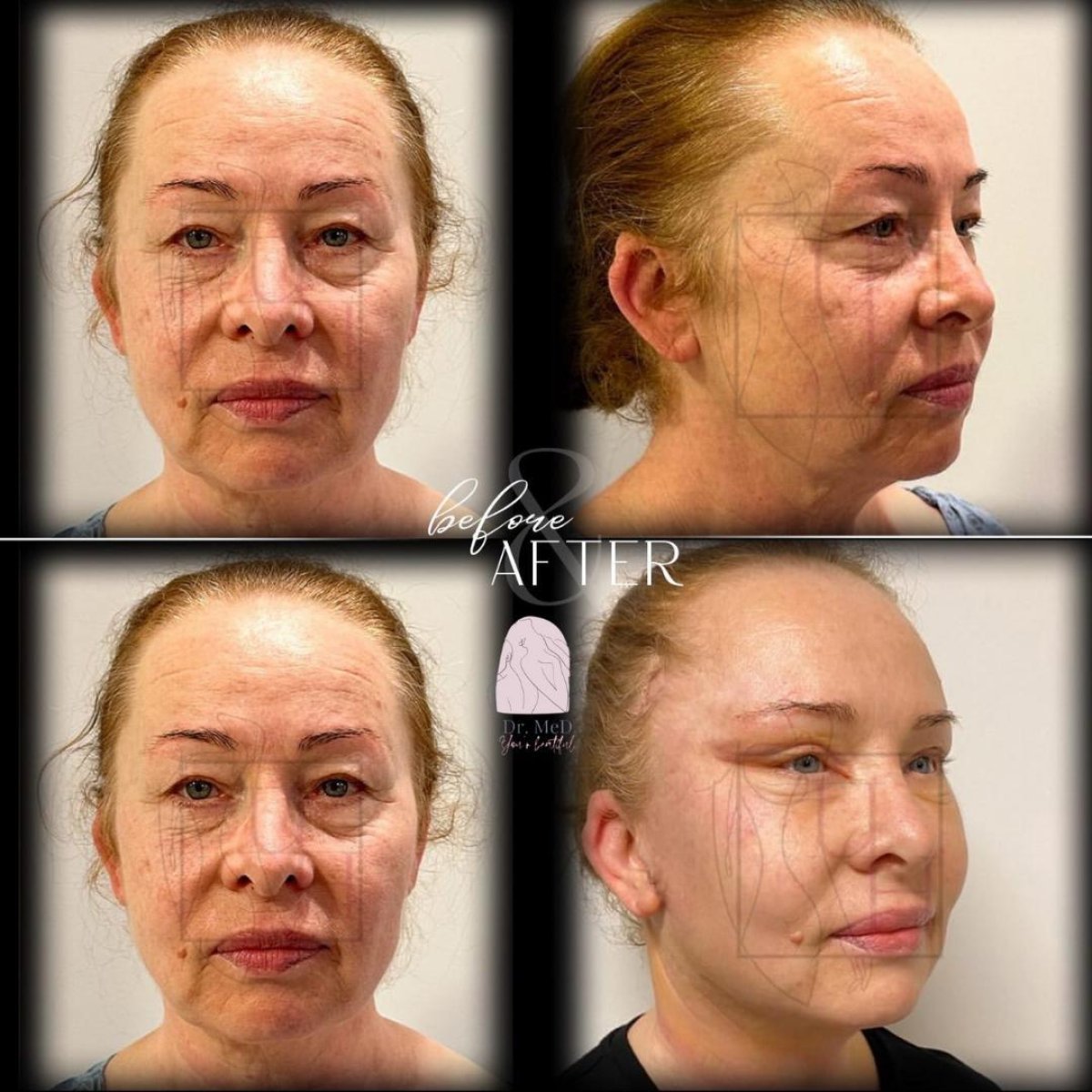 Resultados de lifting facial antes y después en Dr. MED – rejuvenecimiento visible de la piel