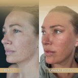 Vorher-nachher-Ergebnis Brauenlifting bei Dr. Safa Manav Clinic, sichtbare Brauenanhebung