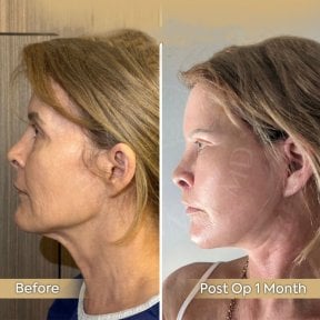 Before and after facial fat transfer result at Dr. Safa Manav Clinic, improved facial volume