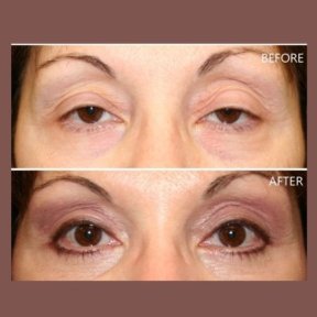 Before and after blepharoplasty results at ID Clinic Bangkok, eyelid correction improvement