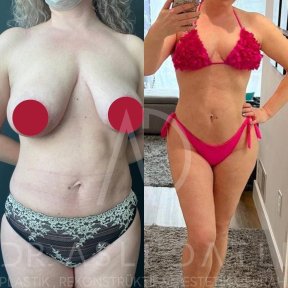 Vorher-nachher-Ergebnis Mommy Makeover bei Liv Hospital Ulus, Körperformung und Bruststraffung