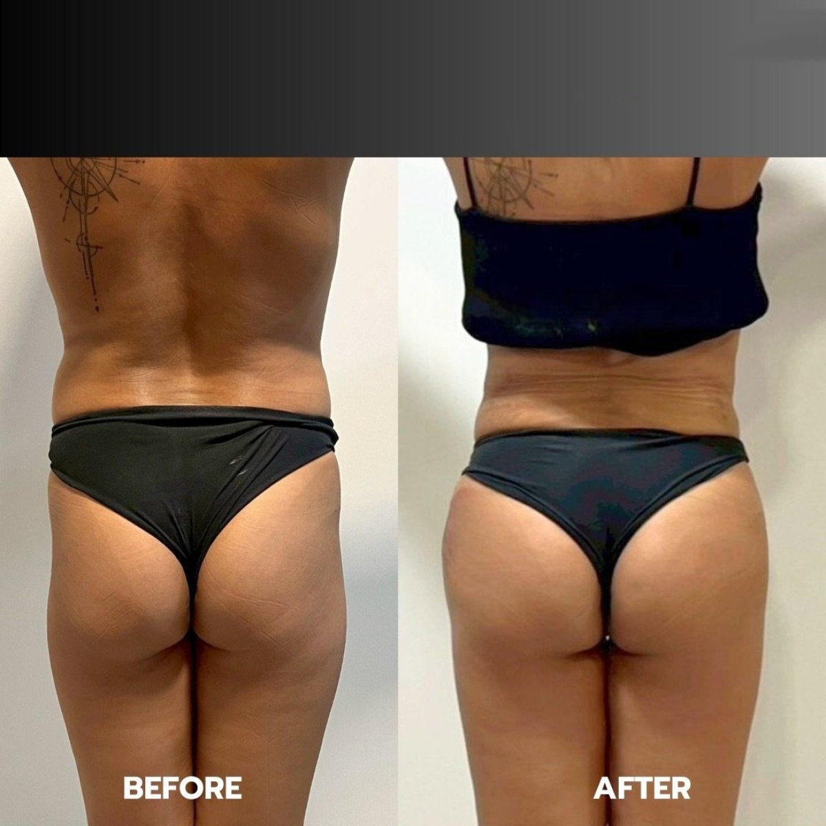 Vorher-nachher-Ergebnis der Vaser-Liposuktion bei ID Clinic Bangkok, sichtbar bessere Körperkontur