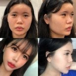 Результаты феминизирующей пластики лица до и после в VG Plastic Surgery, более женственные черты