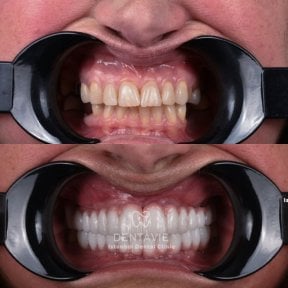 Before and after All-on-4 dental implants result at Dentavie Istanbul Dental Clinic, smile makeover