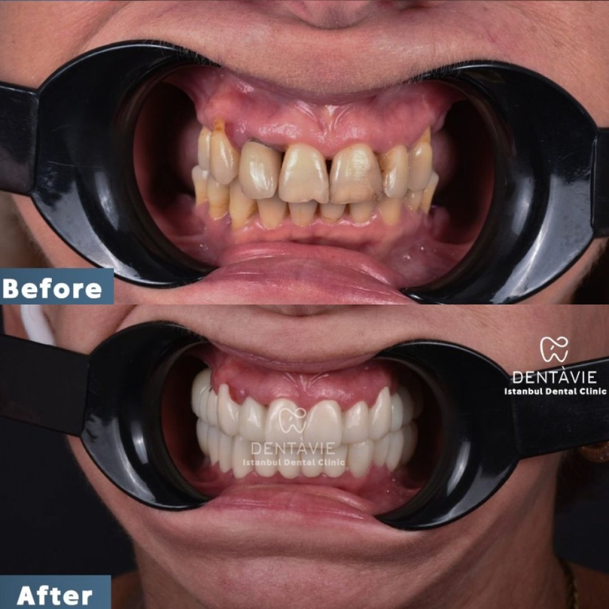 نتيجة قبل وبعد زراعة الأسنان All-on-4 في Dentavie Istanbul Dental Clinic