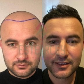 Vorher-nachher-Ergebnis DHI-Haartransplantation bei Estemarley, natürliche Haarlinie