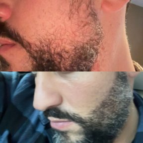 Before and after beard transplant results at Estemarley – fuller, even beard growth