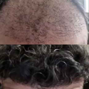 Vorher-nachher-Ergebnis DHI-Haartransplantation bei Estemarley – Haarlinie und Dichte wiederhergestellt