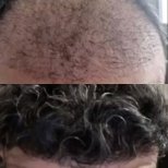 Vorher-nachher-Ergebnis DHI-Haartransplantation bei Estemarley – Haarlinie und Dichte wiederhergestellt