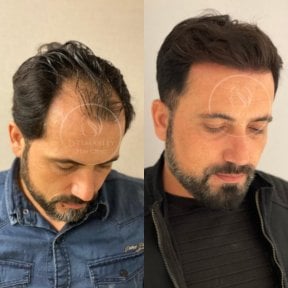 Vorher-nachher-Ergebnis DHI-Haartransplantation bei Estemarley, Haaransatz wiederhergestellt