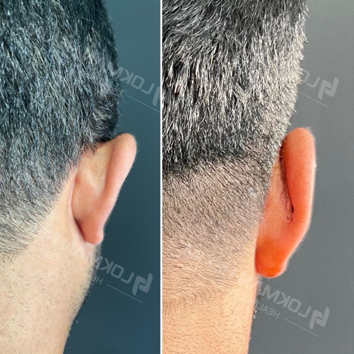 نتائج عملية تجميل الأذن قبل وبعد في مستشفى لوكمان حكيم إسطنبول، تصحيح الأذن