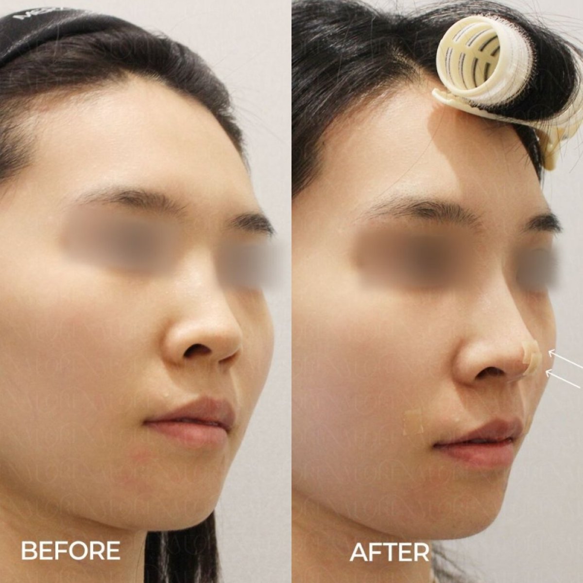 Resultados de lifting con hilos antes y después en Forena Clinic, mejora del contorno facial