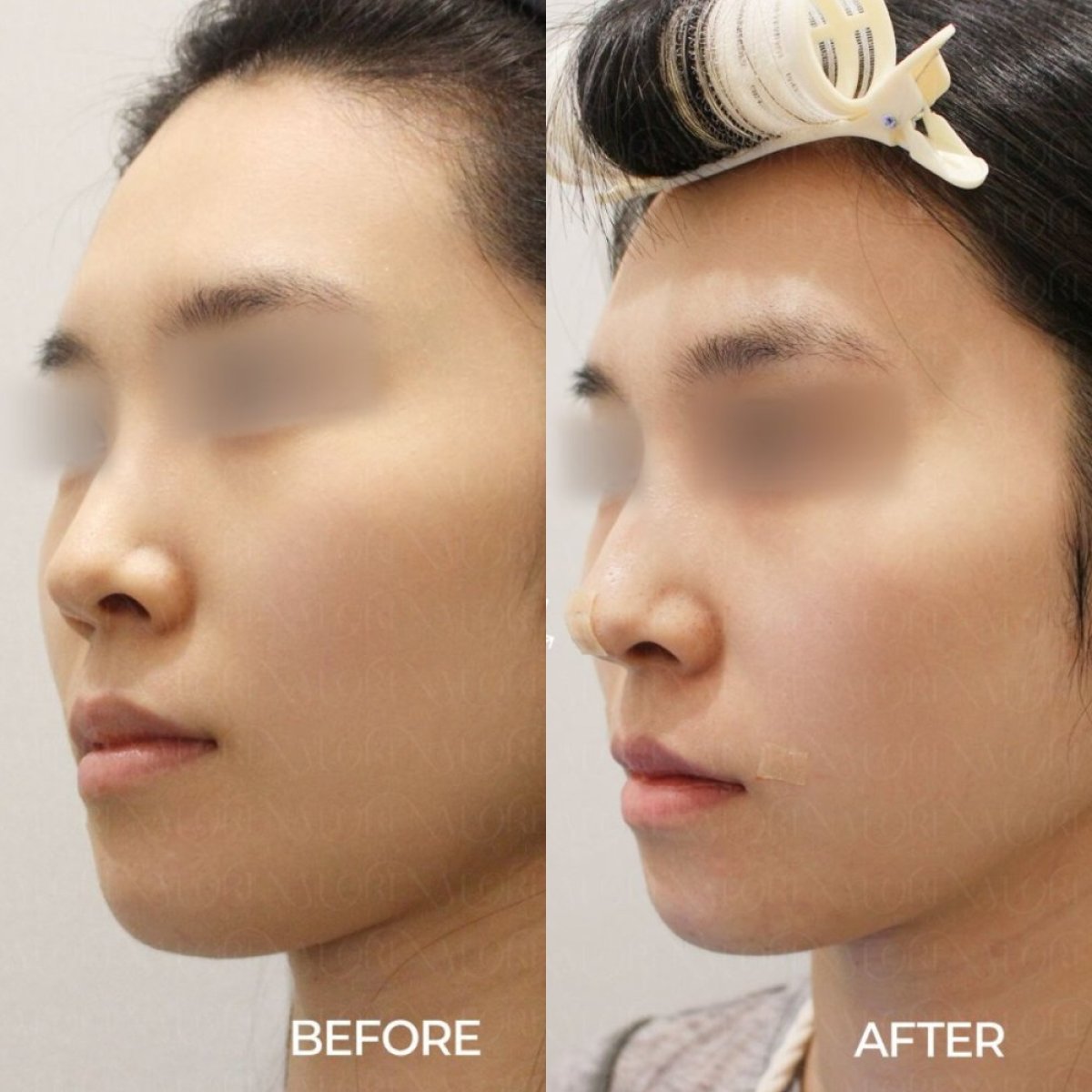 Resultados antes y después de lifting con hilos en Forena Clinic, mejora del contorno facial