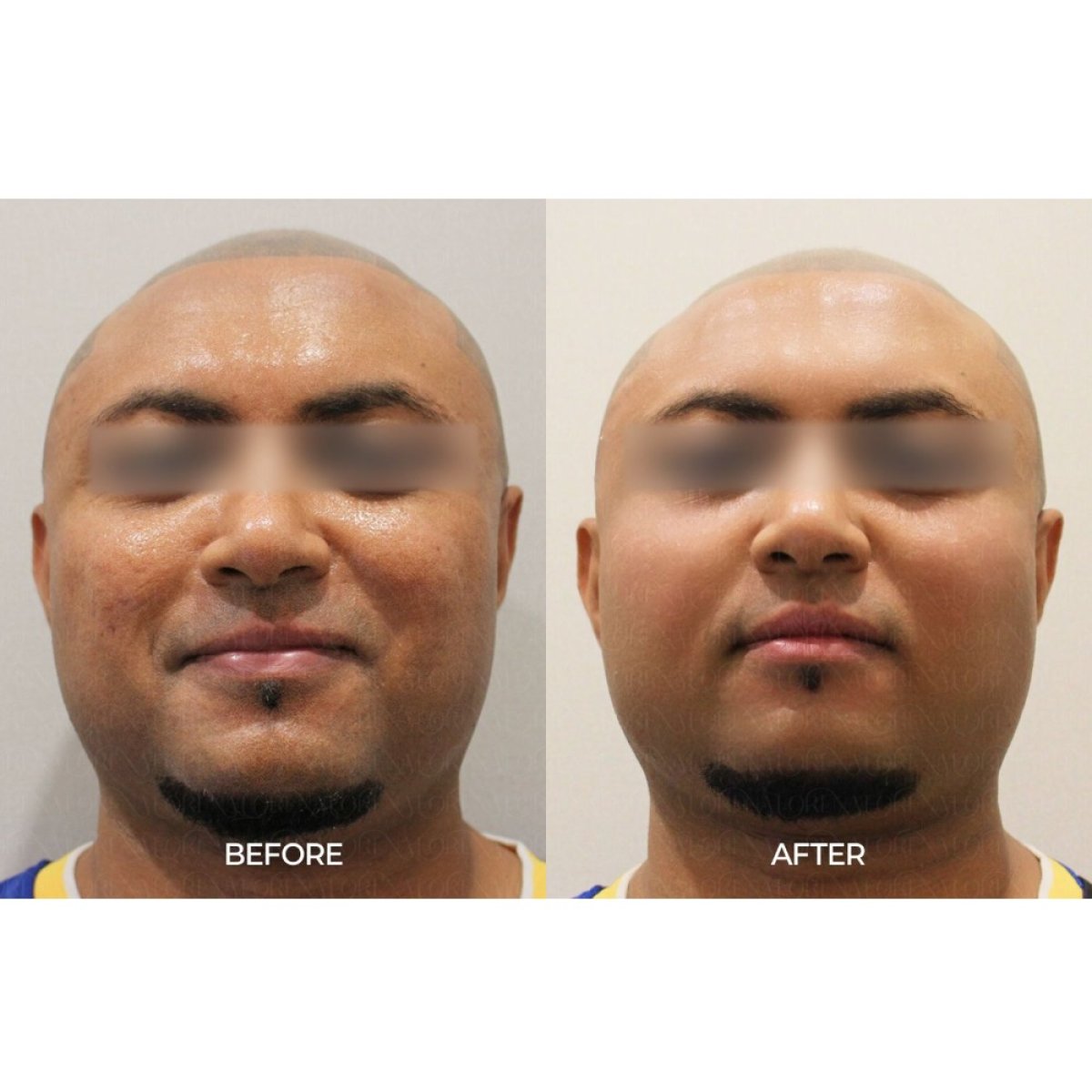 Результаты до и после Thermage в Forena Clinic, видимое улучшение упругости кожи лица