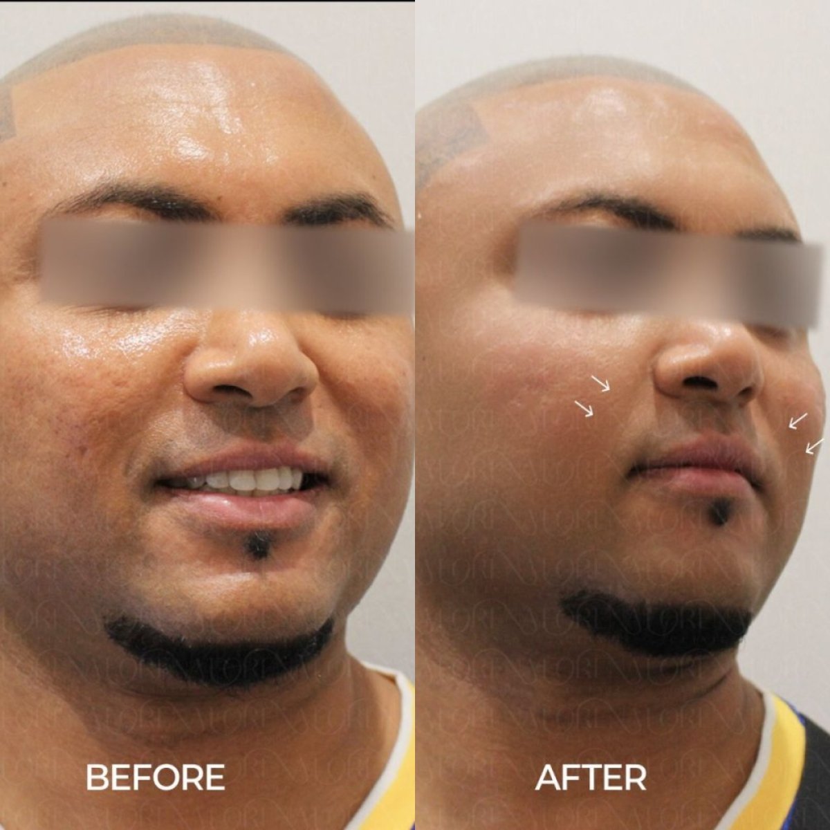 Результаты до и после Thermage в Forena Clinic, видимое улучшение упругости кожи лица