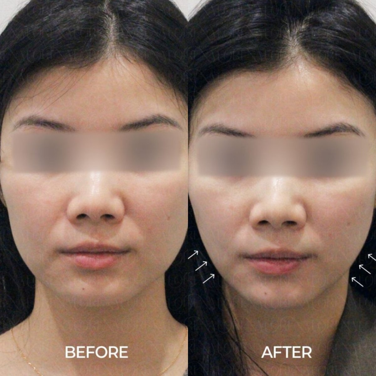 قبل وبعد علاج Ultherapy في Forena Clinic، نتائج شد البشرة واضحة