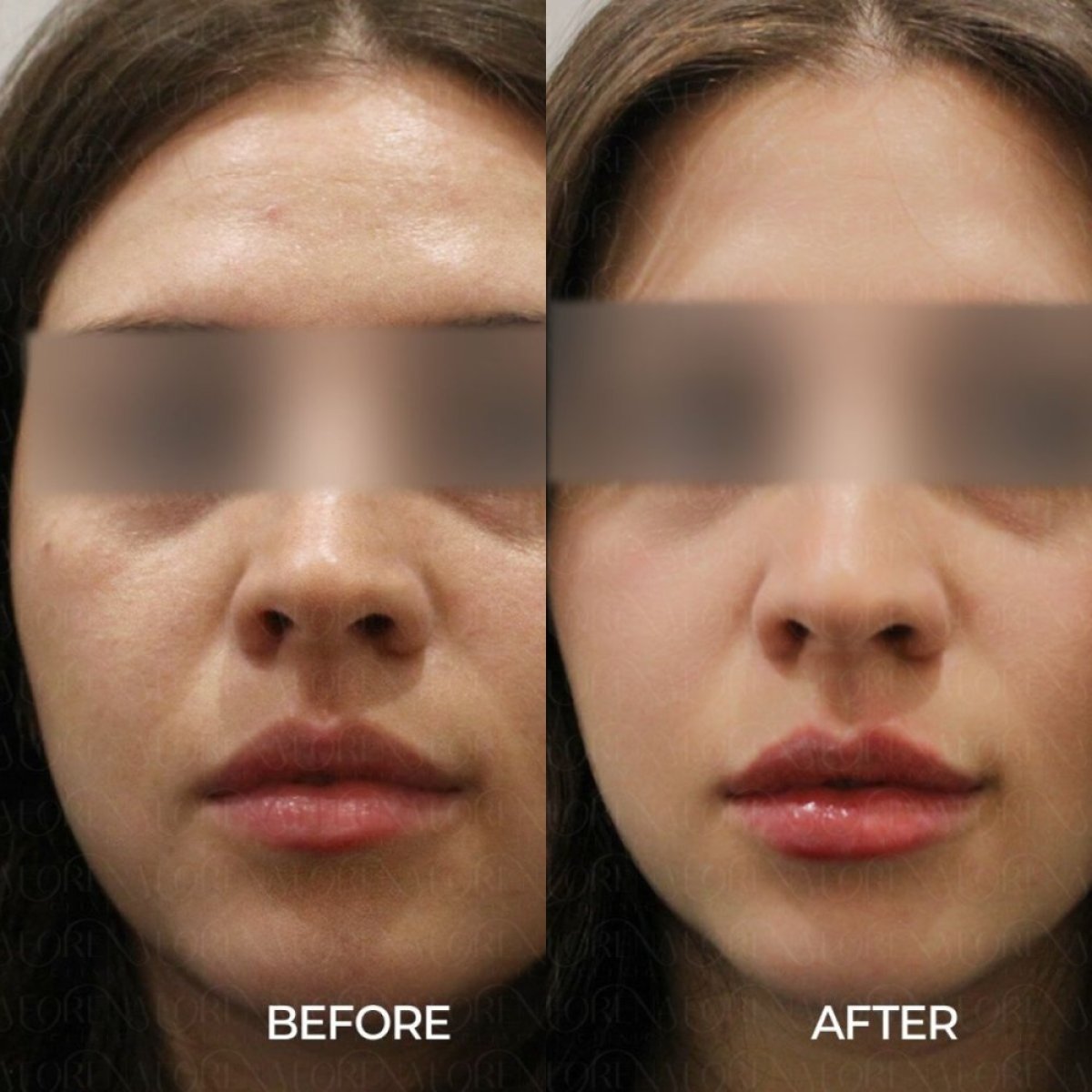 До і після омолодження шкіри у Forena Clinic, покращення текстури шкіри обличчя