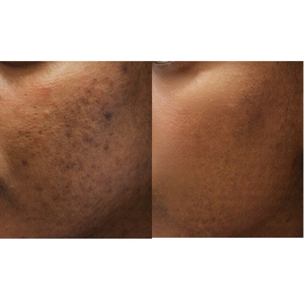 نتائج قبل وبعد علاج تجديد الشباب بالخلايا الجذعية في Forena Clinic لبشرة أكثر نعومة