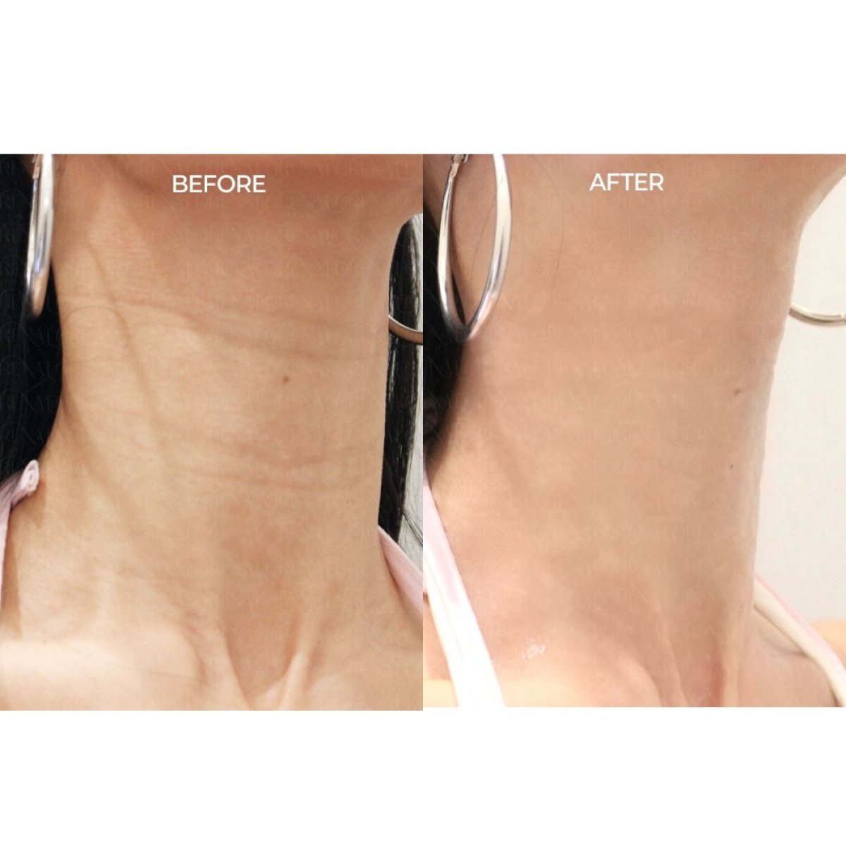 قبل وبعد علاج تجديد الخلايا الجذعية في Forena Clinic، شد جلد الرقبة