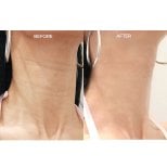Before and after stem cell rejuvenation therapy at Forena Clinic, neck skin tightening result