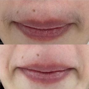 Before and after laser hair removal on upper lip at Wansiri Hospital, smooth skin result