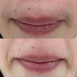 Before and after laser hair removal on upper lip at Wansiri Hospital, smooth skin result