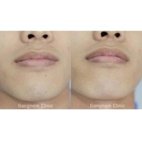 Before and after laser hair removal results on face at Wansiri Hospital, smoother skin