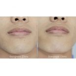 Before and after laser hair removal results on face at Wansiri Hospital, smoother skin