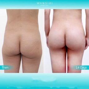 Antes y después de implantes de glúteos en Wansiri Hospital, mejora de forma y volumen