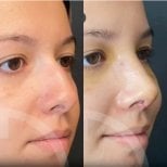 Before and after revision rhinoplasty results at Liv Hospital Ulus, improved nose shape