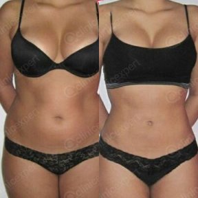Before and after liposuction results at CE International Hospital, improved waist contour